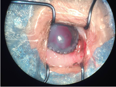 华南首例晶状体水平脱位合并玻璃体脱出手术