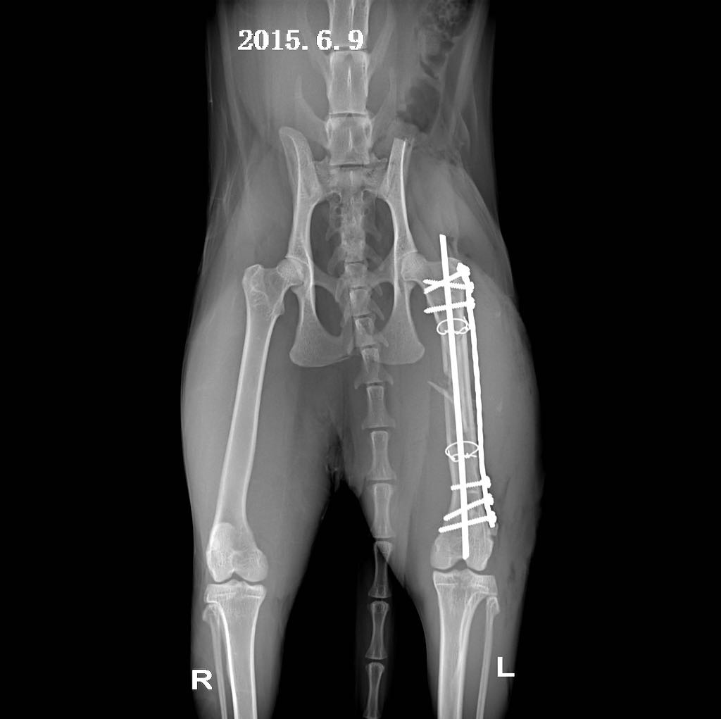 股骨粉碎性骨折