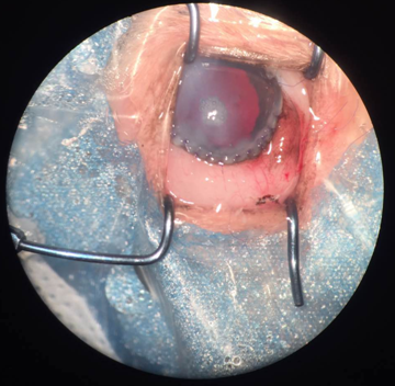 华南首例晶状体水平脱位合并玻璃体脱出手术