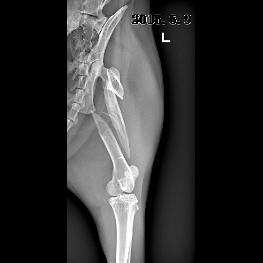 股骨粉碎性骨折