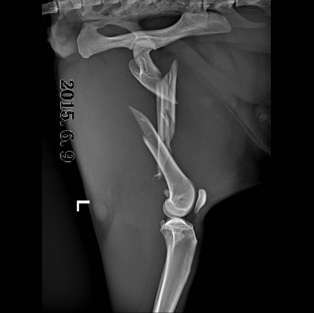 股骨粉碎性骨折